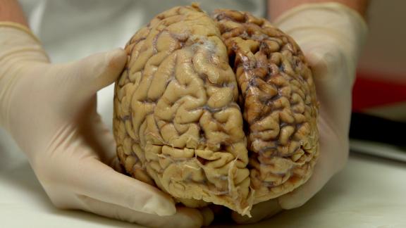 Latest studies Brain disease from contact sports more common ABC7