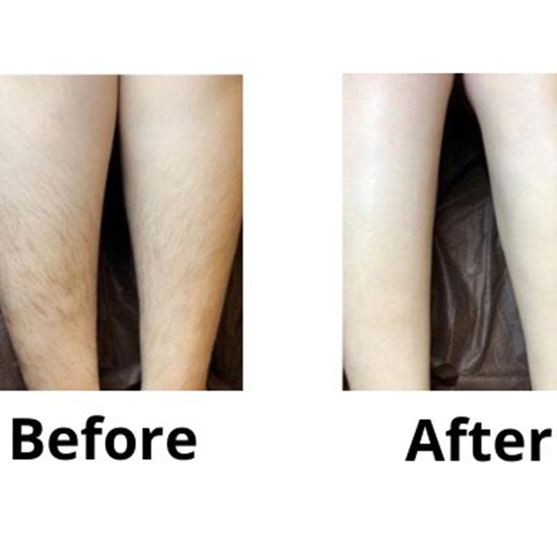 Bikini and Brazilian Laser Hair Removal [Full Guide!]