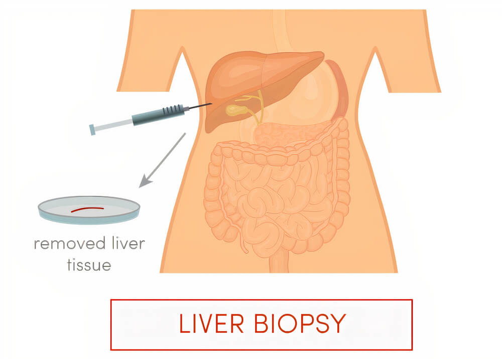 Liver Biopsy; Indications, Contraindications, Preparing and Procedure