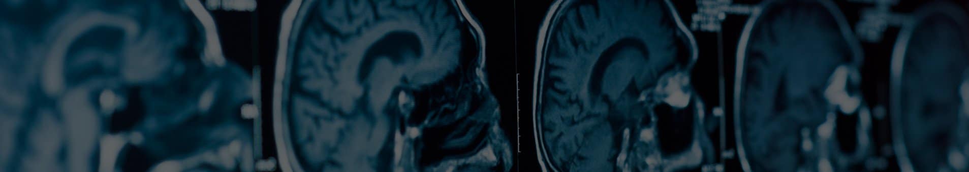 LA Traumatic Brain Injury Lawyer Los Angeles TBI Attorney