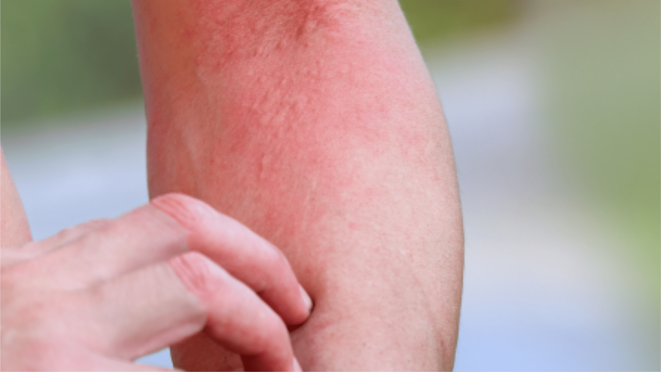 What is Chronic Itching (Pruritus)? What Causes Pruritus?