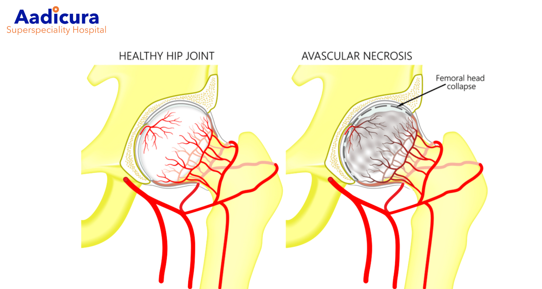 Hip AVN (Avascular Necrosis) Symptoms & Causes
