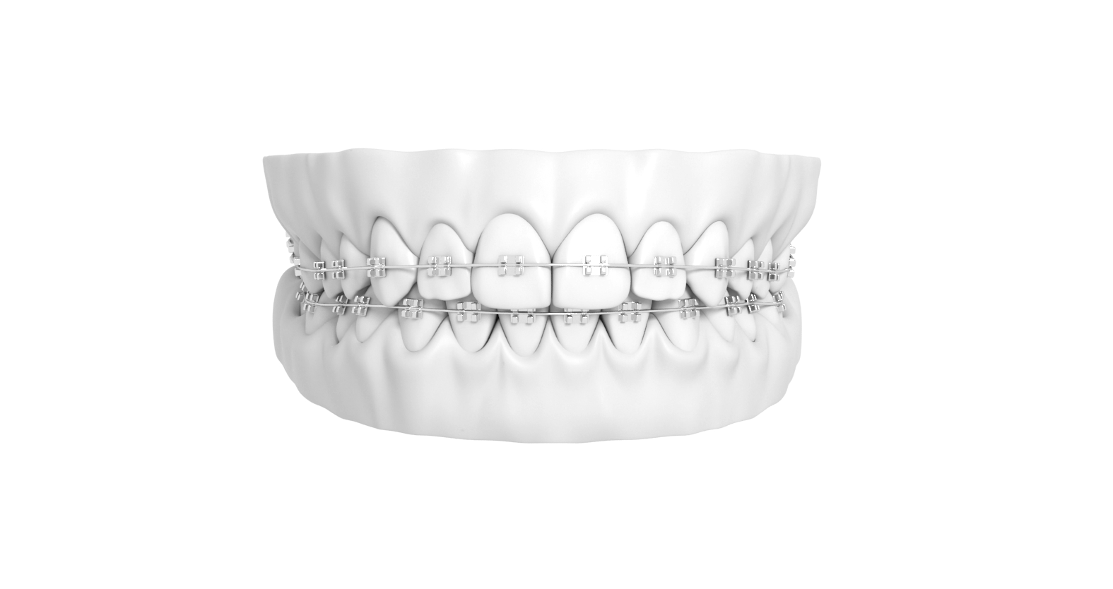 How Braces Work A Comprehensive Guide American Association of Orthodontists