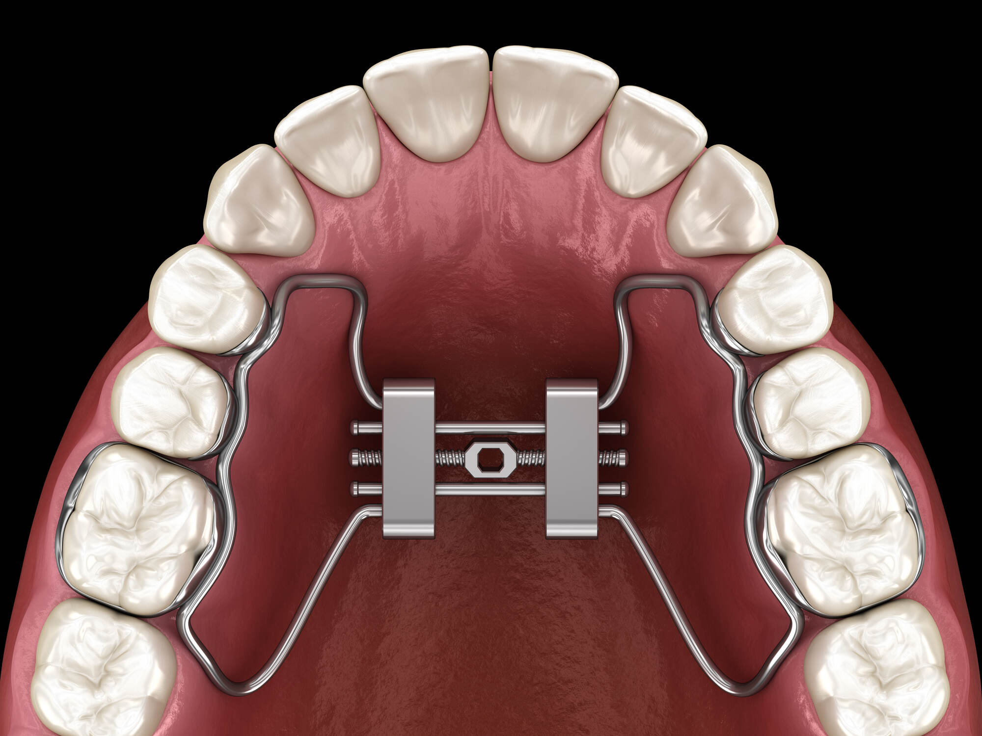 What is a Palatal Expander, and What is it Used For? American Association of Orthodontists