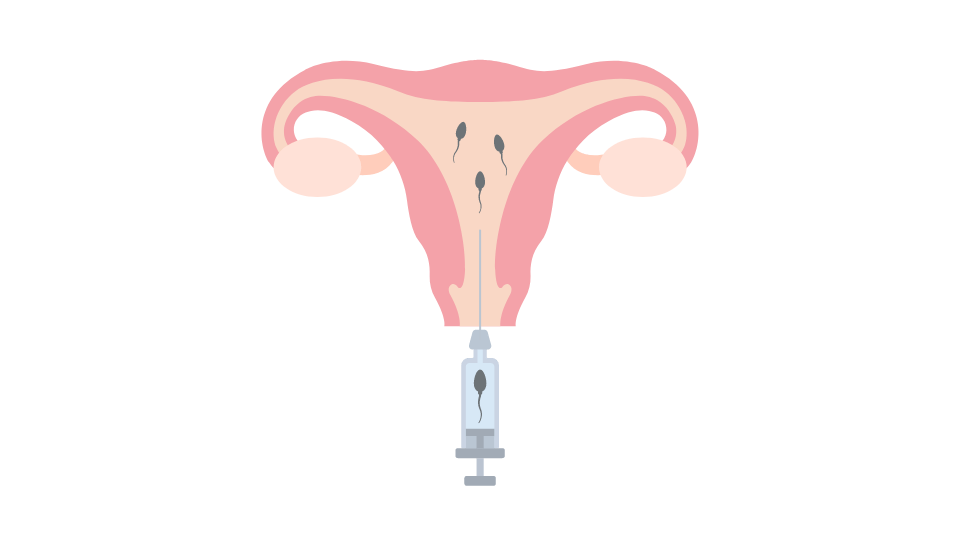 What Happens After IUI Day By Day Simple Guide