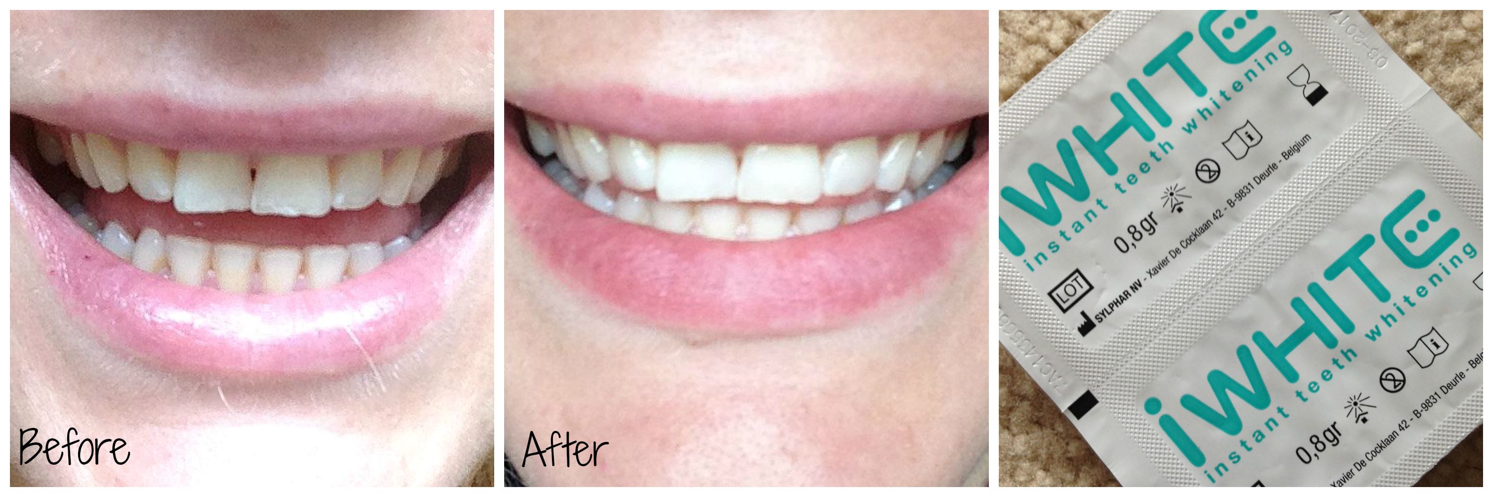 Teeth Whitening What Are Your Options? AAUBlog
