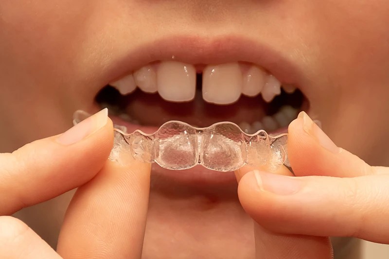 Do you sleep with Invisalign?