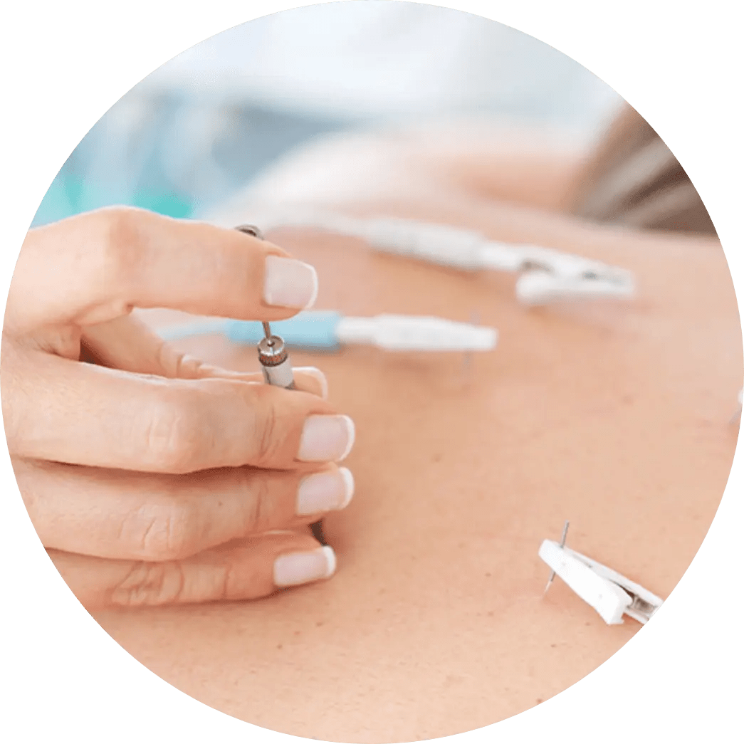 Electroacupuncture A Balanced Life Therapies