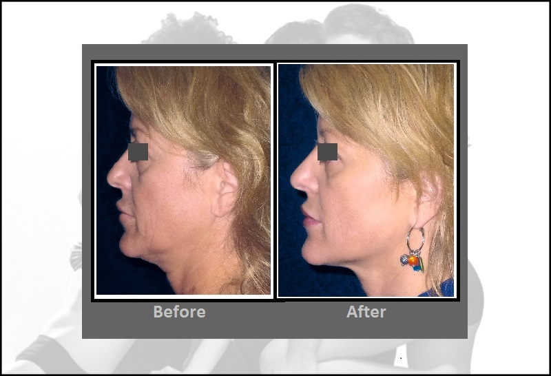 Precision Tx (Sidelaze) Laser Face & Neck Lifts Hartford CT