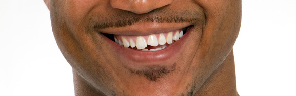 DIY Chipped Tooth Repair Abbeyfield Blog