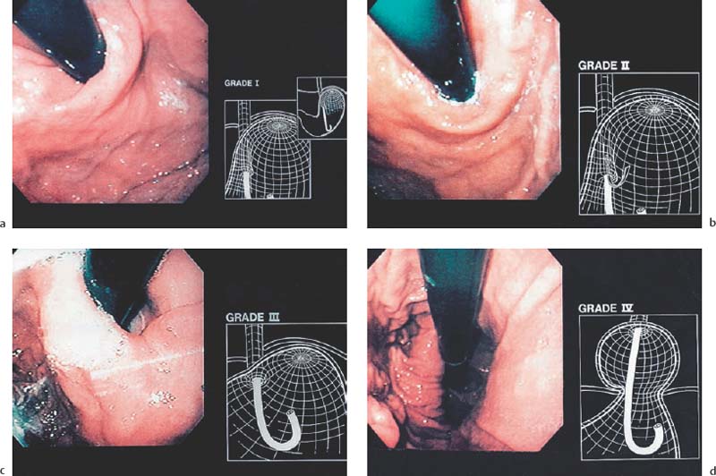 OrganRelated Staging and Grading Abdominal Key