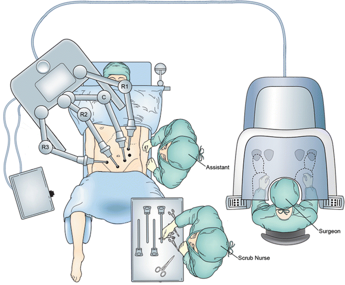 Robotic Technique for Right Colectomy Abdominal Key