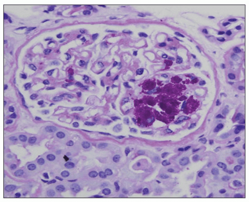 Pyelonephritis and Other Direct Renal Infections, Reflux Nephropathy