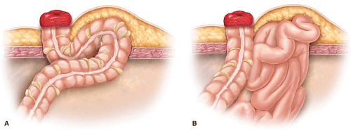 Parastomal Hernia Repair Abdominal Key
