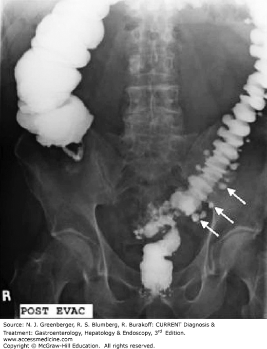 Diverticulitis Barium Enema
