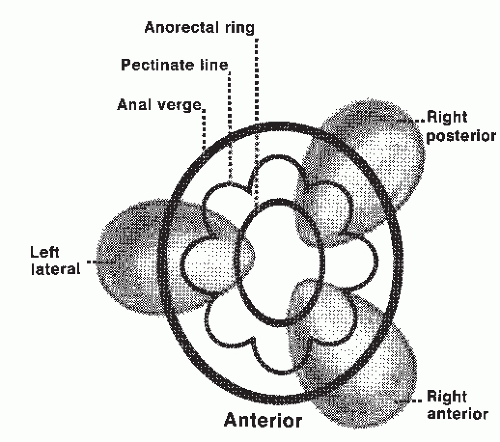 Hemorrhoids | Abdominal Key