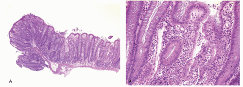 Inflammatory Bowel Diseases Abdominal Key
