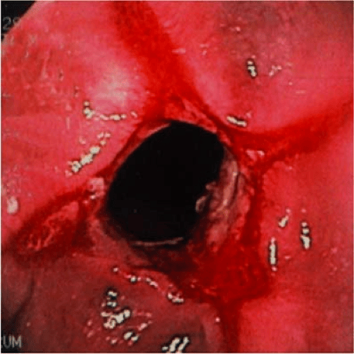 Esophagitis Abdominal Key