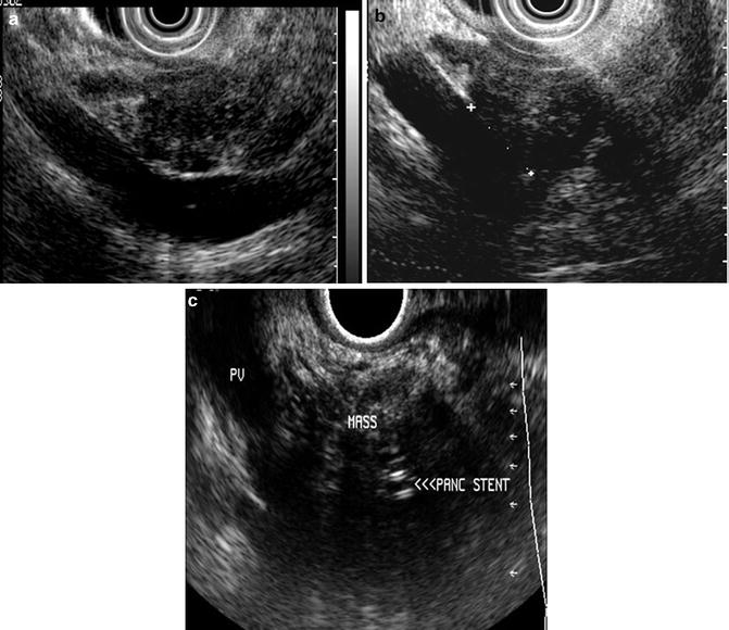 Endoscopic Ultrasonography Staging and Therapeutic Interventions