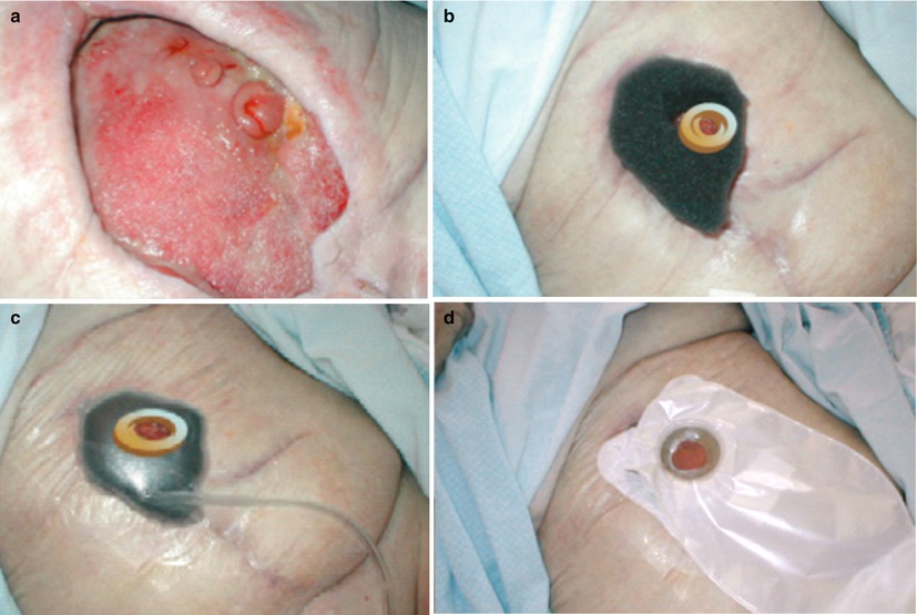 Enterocutaneous Fistulas Abdominal Key