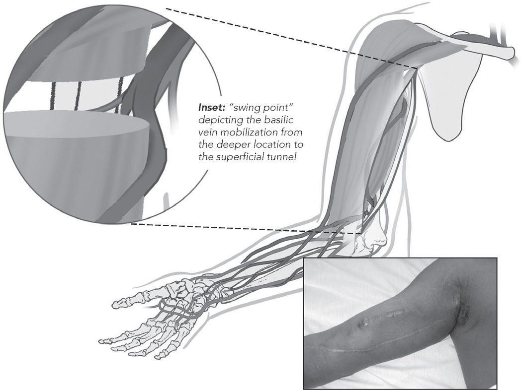 Arteriovenous Fistulas and Grafts The Basics Abdominal Key