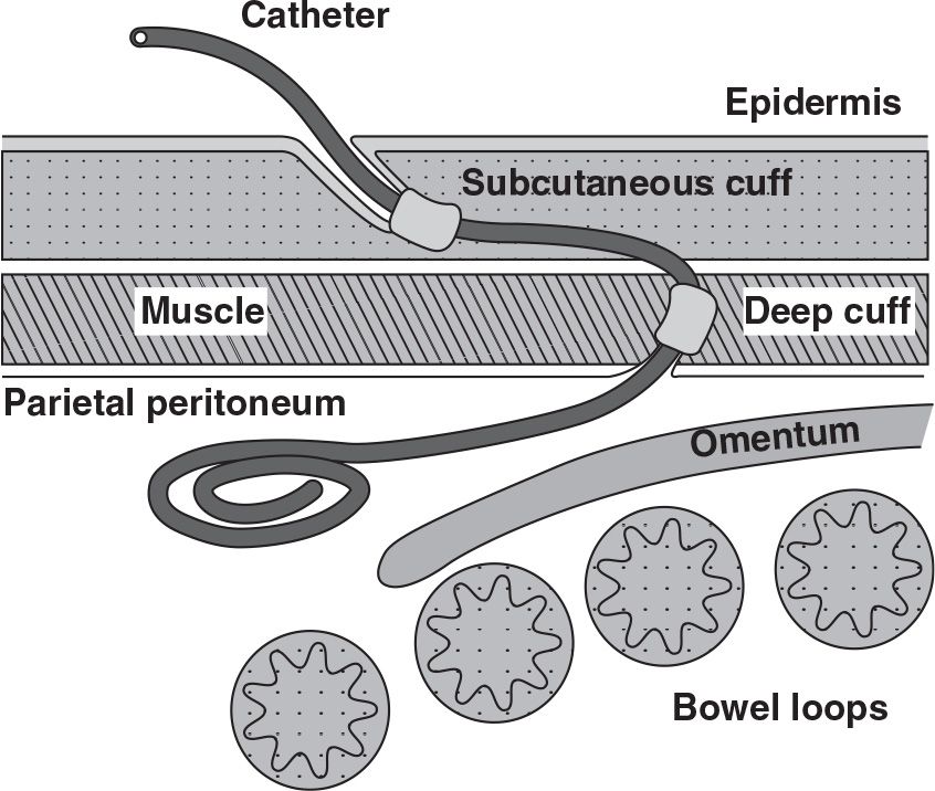 Peritoneal Dialysis Catheters, Placement, and Care Abdominal Key