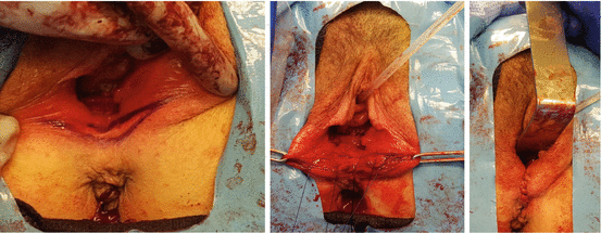 Posterior Colporrhaphy (With or Without Perineorrhaphy) | Abdominal Key
