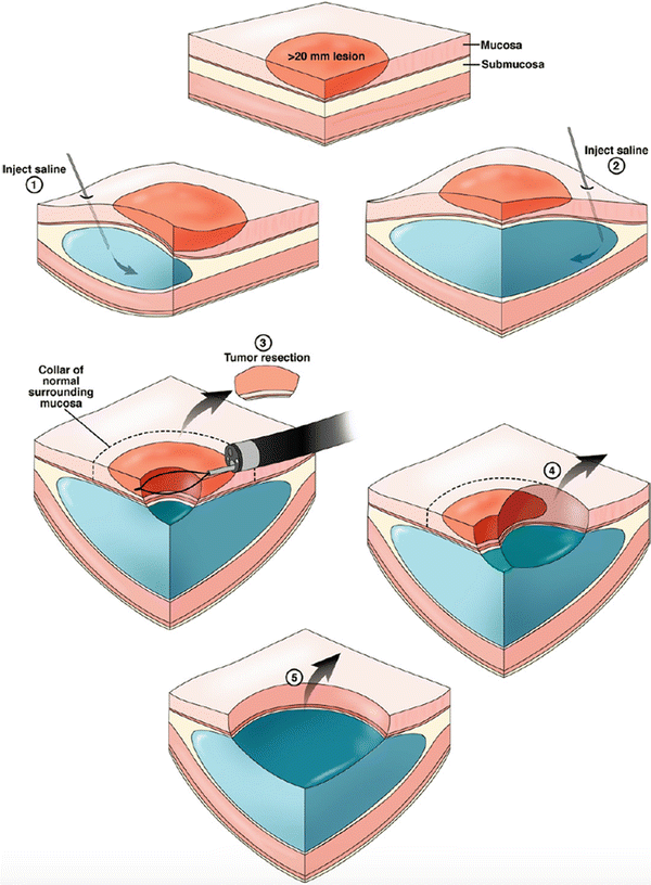 Endoscopic Mucosal Resection (EMR) Abdominal Key