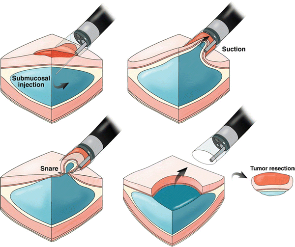 Endoscopic Mucosal Resection (EMR) Abdominal Key