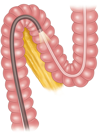 Anatomic Basis of Colonoscopy | Abdominal Key