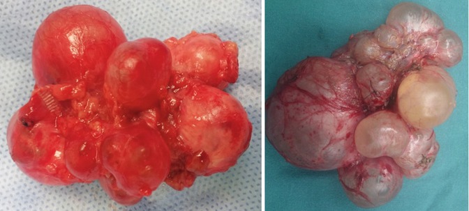 Hydronephrosis in Infants and Children Abdominal Key