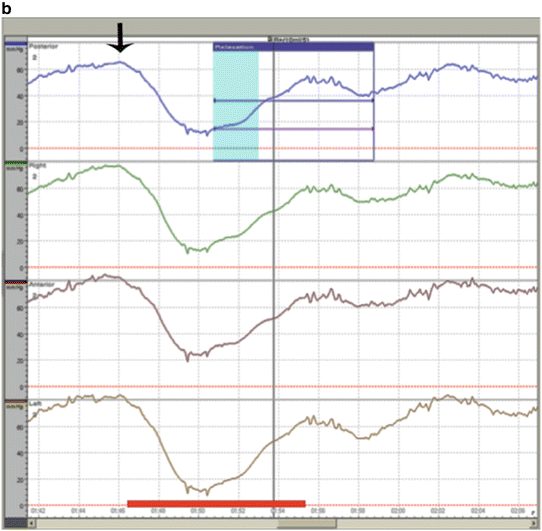 Anorectal Manometry Abdominal Key