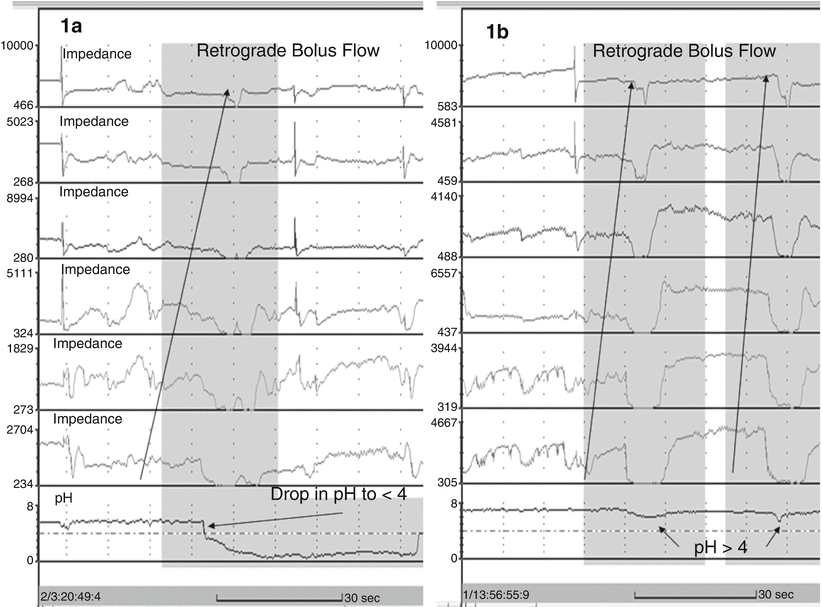 Esophageal pH and Impedance Monitoring Abdominal Key