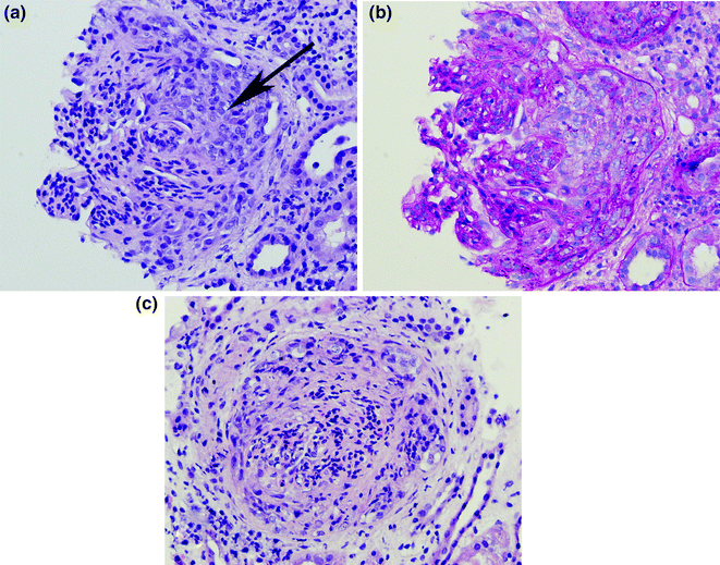 Acute Poststreptococcal Glomerulonephritis Abdominal Key
