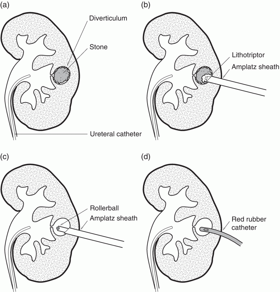Percutaneous Nephrolithotomy of Calyceal Diverticula, Infundibular
