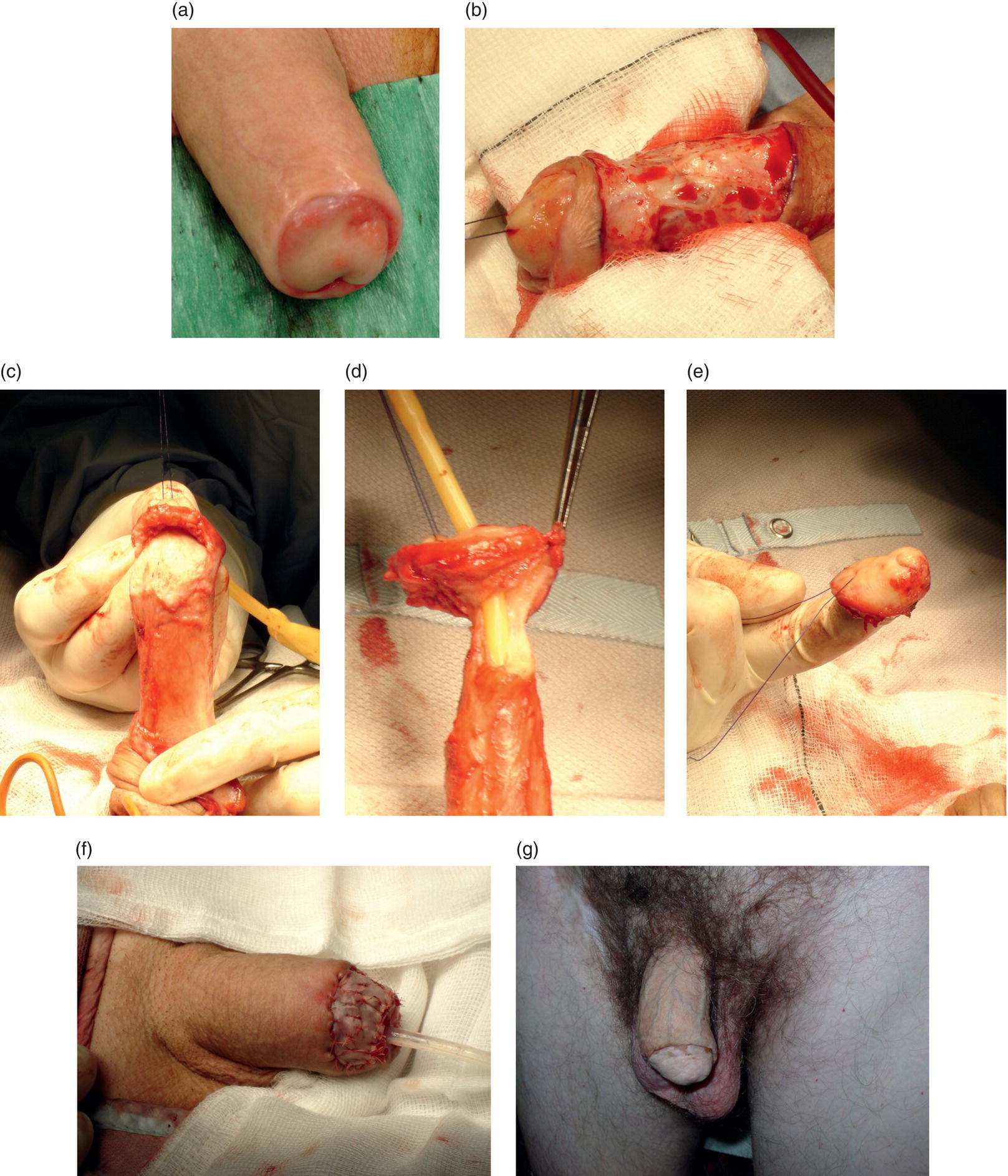 Glansectomy Pics