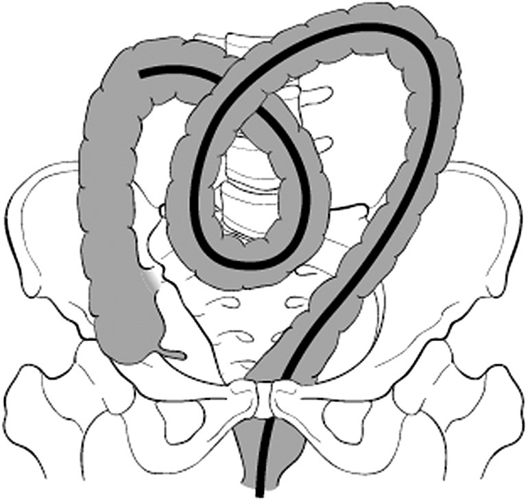 Pediatric ileocolonoscopy Abdominal Key
