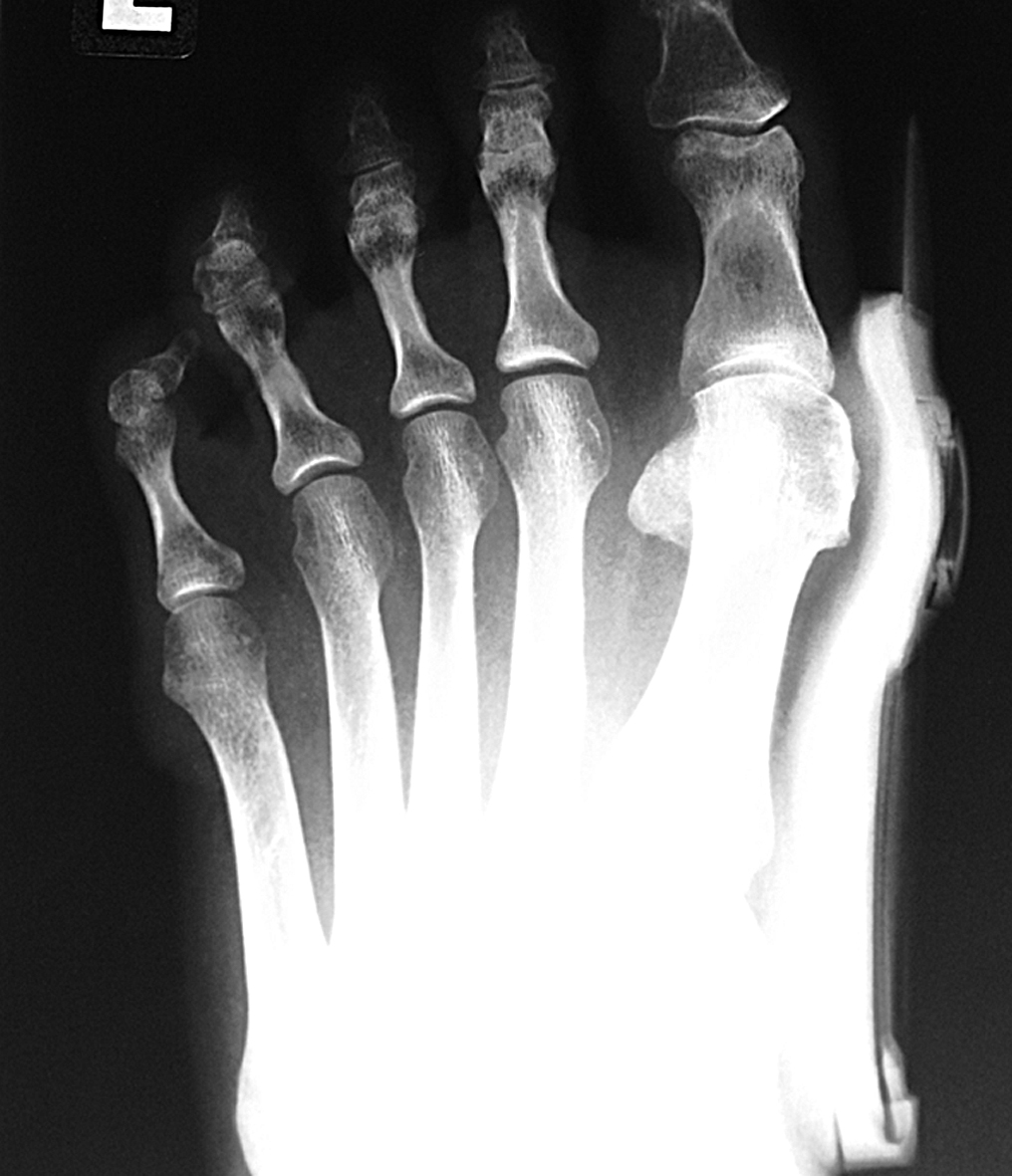 Bunion Aid Brace Medical Supplies Equipment Store San Francisco, CA