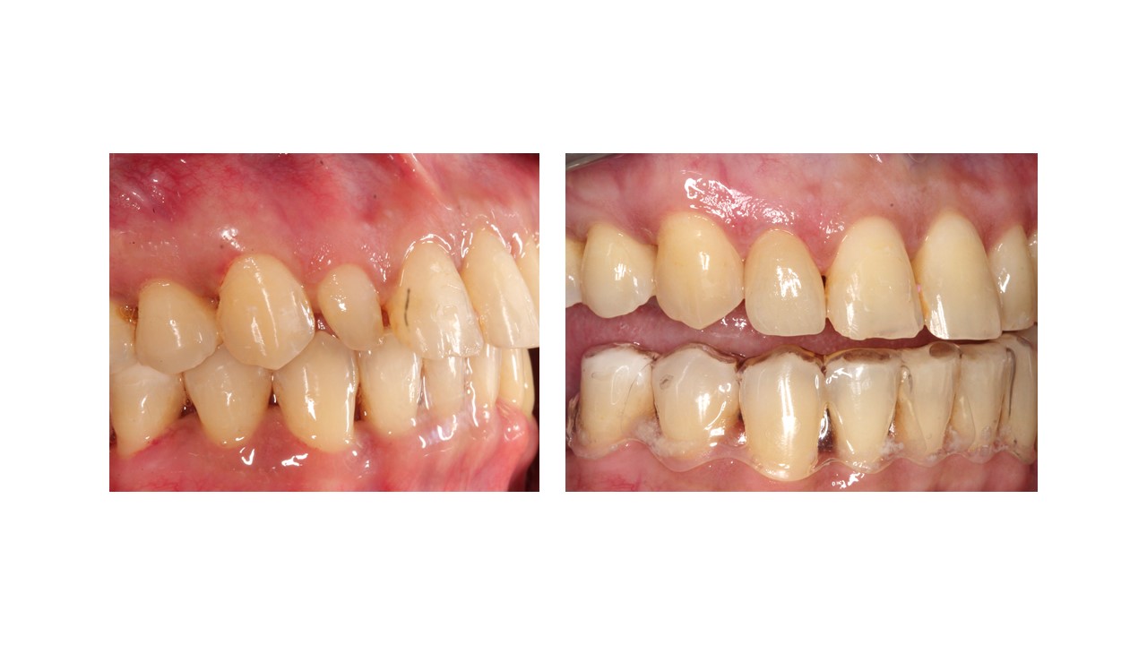 PROCEDURES AFTER BRACES TREATMENT About Braces