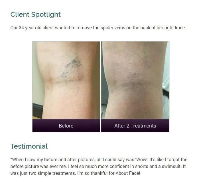 All About Laser Treatment For Spider Veins About Face Anti Aging