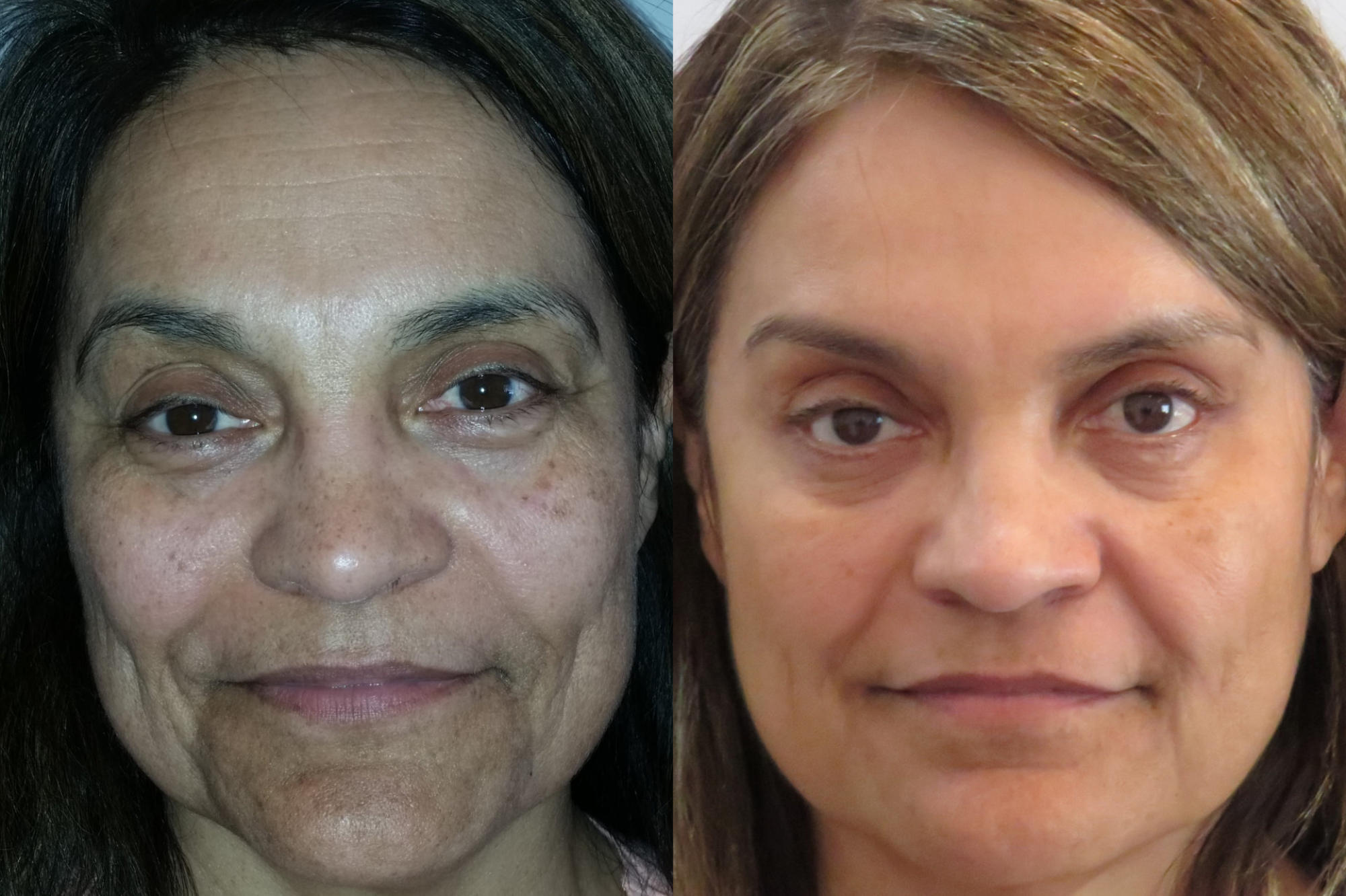 Alexandria Hair Removal Presept™ Skin Cleanser Alexandria