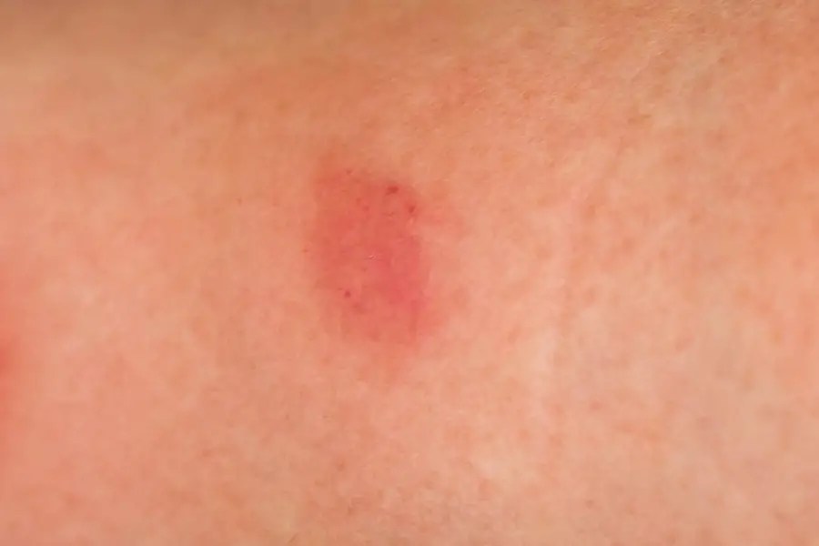 Do Palmetto Bugs Bite? APB