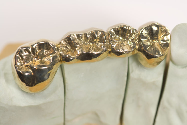 Crowns and Bridges ABQ Dental Associates