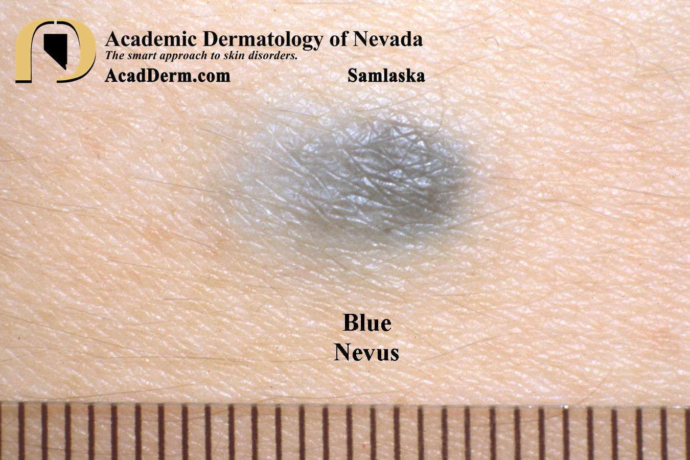 Blue Nevus Academic Dermatology of Nevada