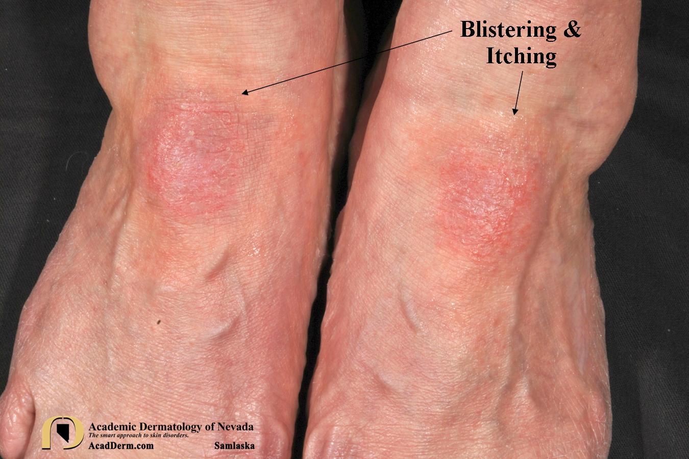 Dermatology Detective...Contact Dermatitis Academic Dermatology of Nevada