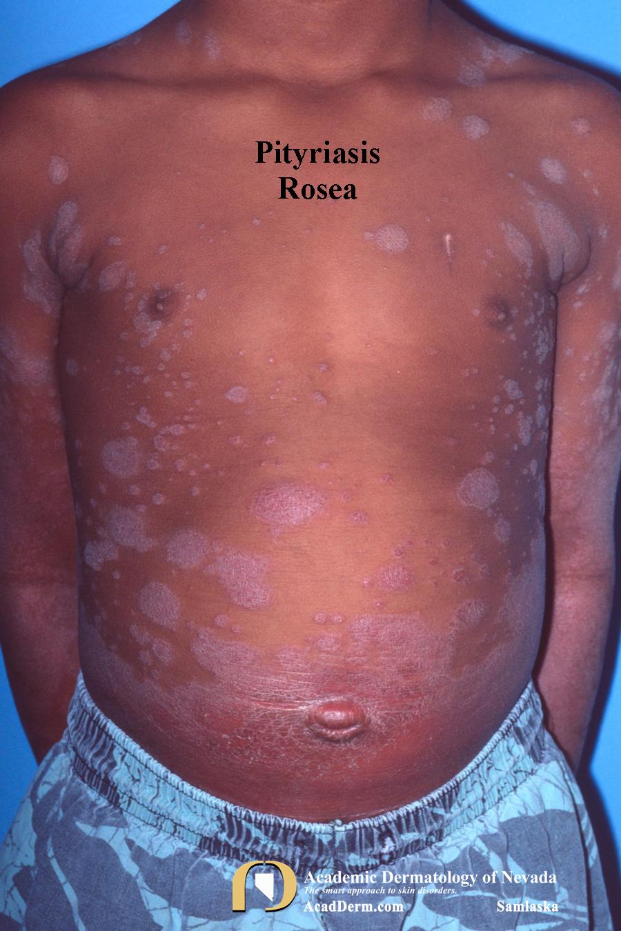 Pityriasis RoseaIt starts with a Herald Patch... Academic