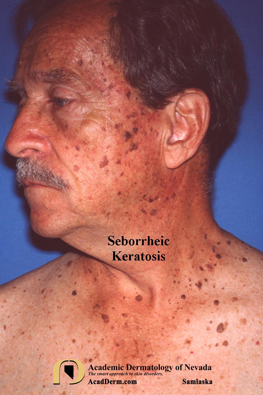 Seborrheic Keratosis Barnacles of life... Academic Dermatology of Nevada