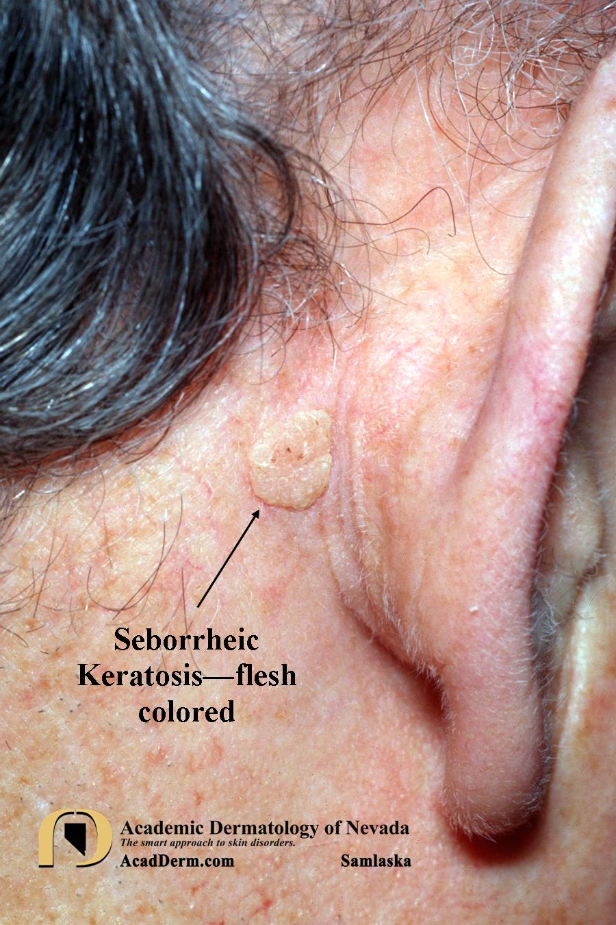 Seborrheic Keratosis Atypical Forms... Academic Dermatology of Nevada