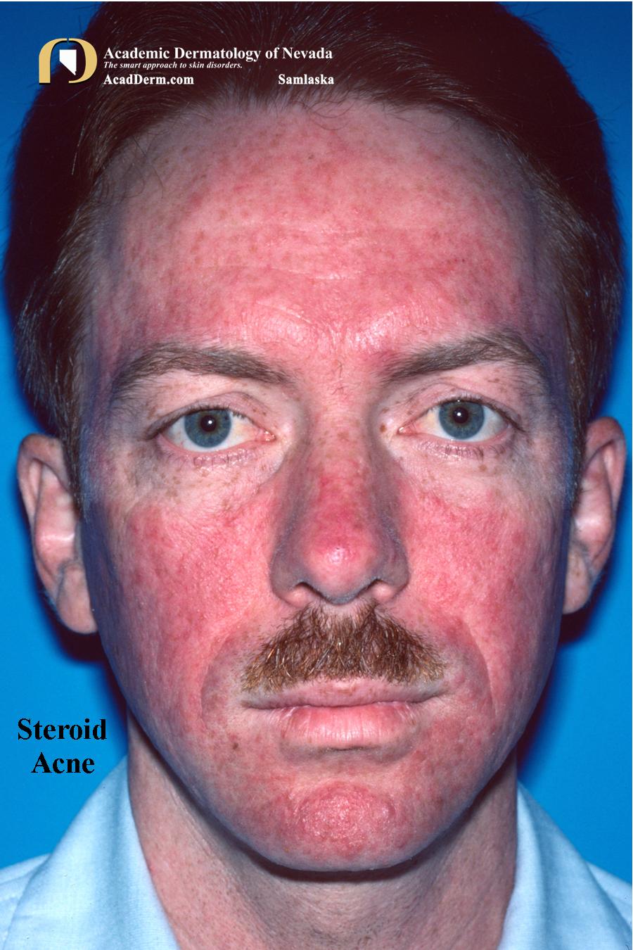 Acne Medicamentosa A Side Effect of Medicines Academic Dermatology