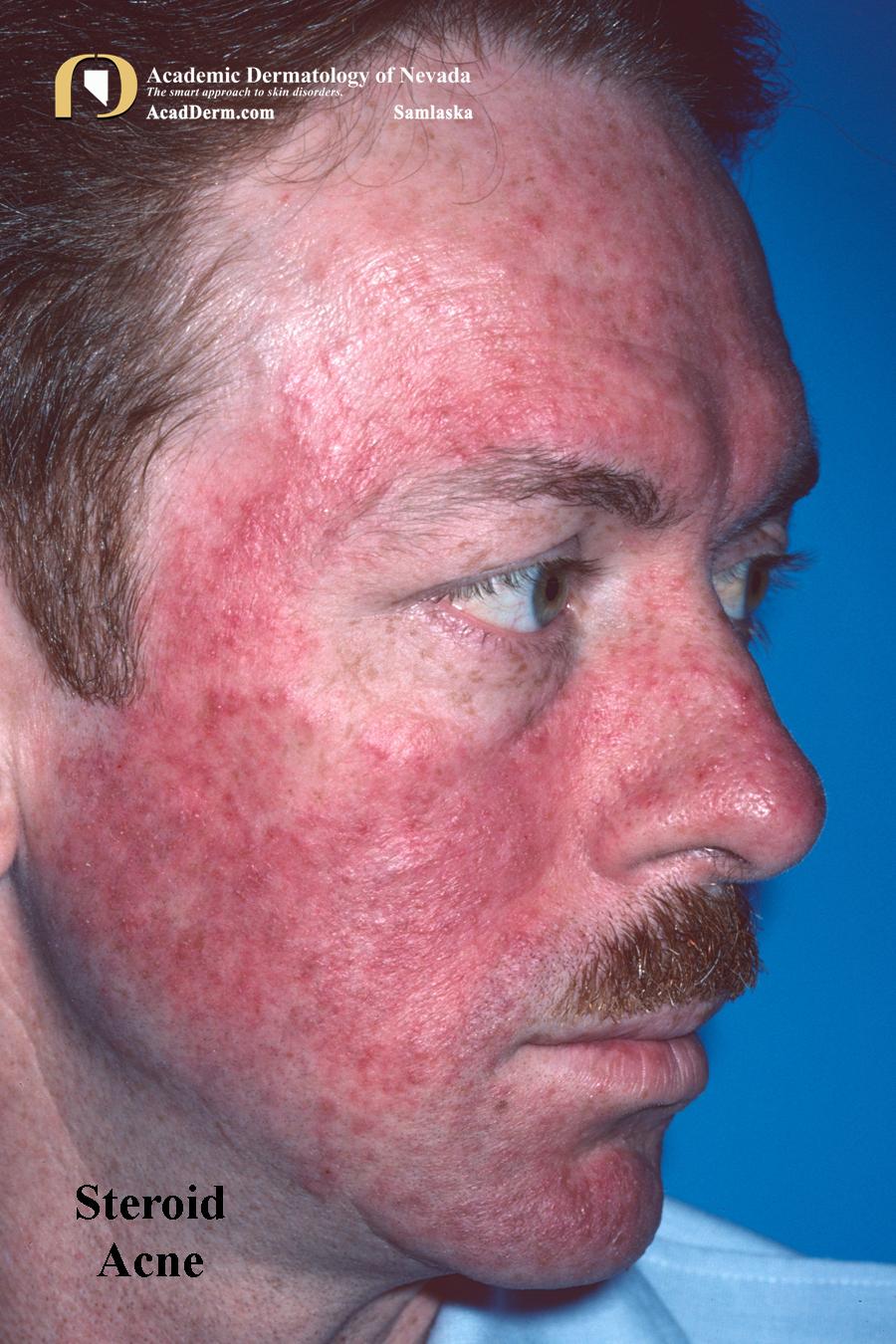 Acne Medicamentosa A Side Effect of Medicines Academic Dermatology